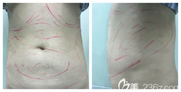 面诊扬州美贝尔医生术前腰腹部赘肉 面诊扬州美贝尔医生术前腰腹部赘肉