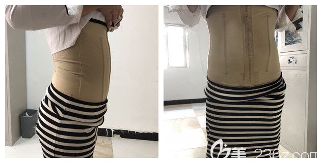 刚做完腰腹部吸脂术后穿着塑身衣 刚做完腰腹部吸脂术后穿着塑身衣