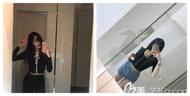 做腰腹部吸脂术后一个月恢复 做腰腹部吸脂术后一个月恢复