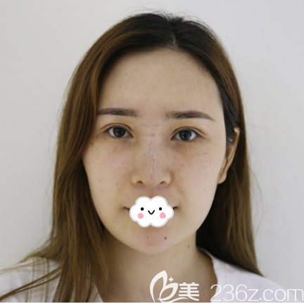 术前塌鼻子照片 术前塌鼻子照片