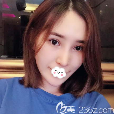 广州紫馨李石峰隆鼻术后15天自拍 广州紫馨李石峰隆鼻术后15天自拍