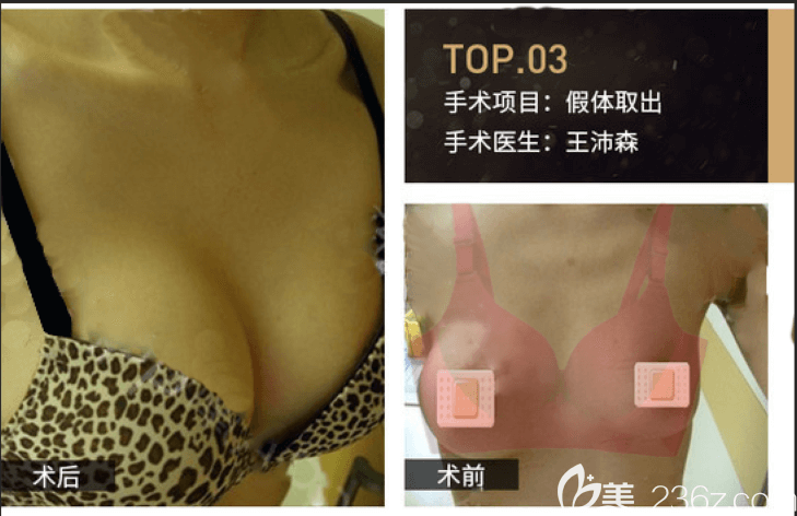 北京京韩王沛森胸部假体取出同期脂肪丰胸案例