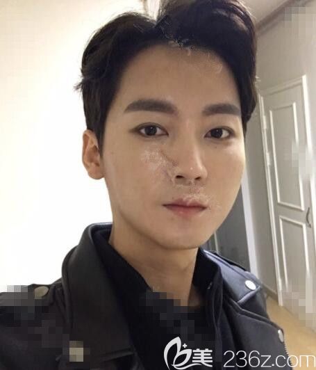 单眼皮好凶韩国芭堂额头提升+埋线双眼皮后感觉自己帅帅的哒