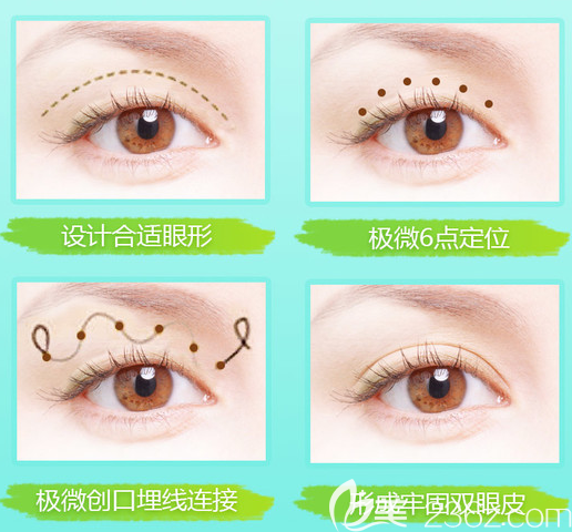 广州紫馨付巨峰双眼皮手术特点