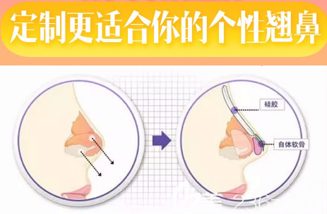 广州紫馨付巨峰隆鼻手术示意图