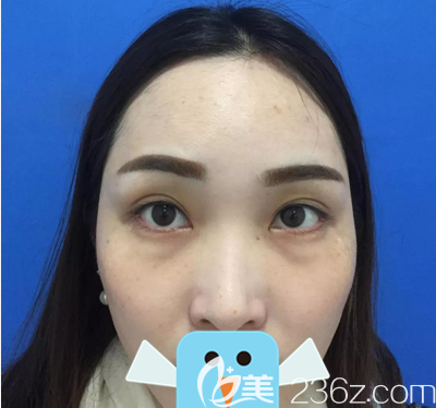 去眼袋术前素颜照片 去眼袋术前素颜照片