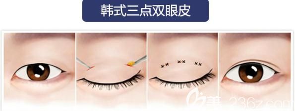 易韩定制韩式双眼皮