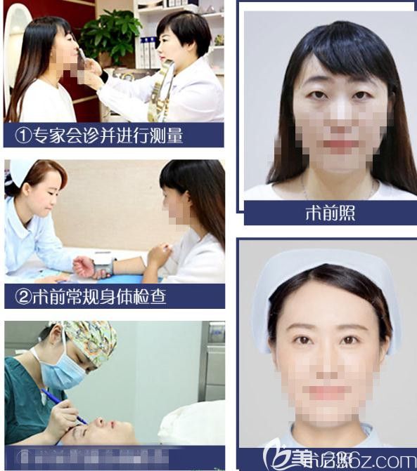 解密双眼皮手术流程让你做的放心