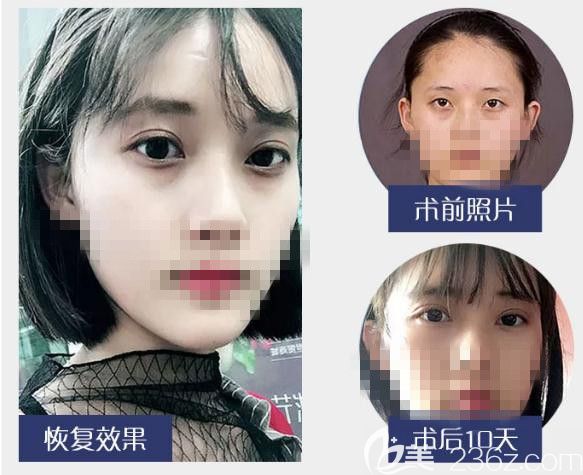 双眼皮真人案例效果