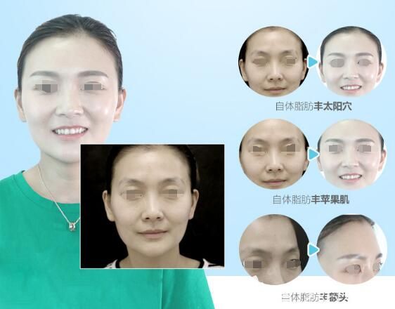 在徐州时光洪扬做自体脂肪面部填充案例 在徐州时光洪扬做自体脂肪面部填充案例