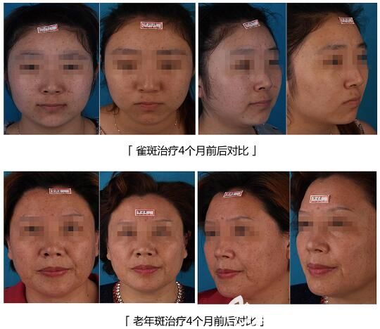 找曹洪扬医生祛斑案例 找曹洪扬医生祛斑案例