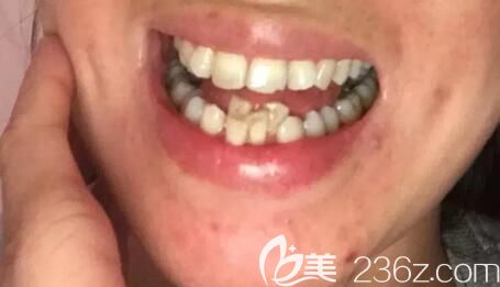 我在郑州德正口腔做牙齿矫正前的照片 我在郑州德正口腔做牙齿矫正前的照片