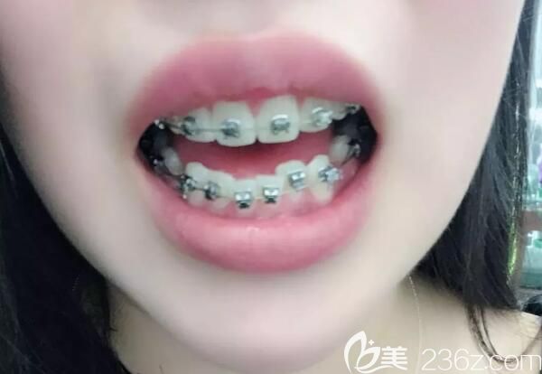 我在郑州德正口腔做金属托槽牙齿矫正第5个月