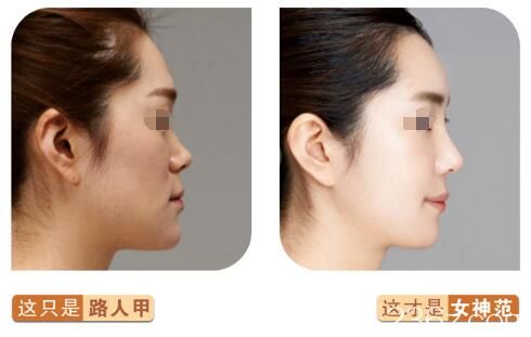 找曹洪扬医生隆鼻案例 找曹洪扬医生隆鼻案例