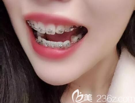 我在郑州德正口腔做牙齿矫正第9个月 我在郑州德正口腔做牙齿矫正第9个月