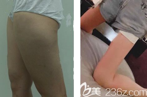 兰州韩美陈诚腿部吸脂案例 兰州韩美陈诚腿部吸脂案例