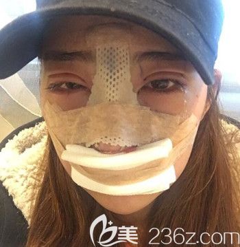 韩国朱诺做眼综合+鼻综合手术当天