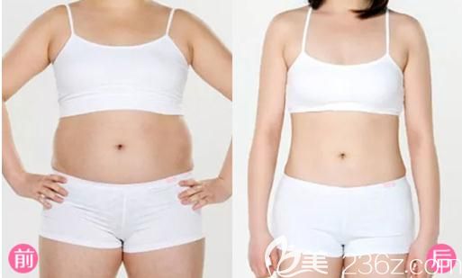 信阳易韩安和吸脂手术