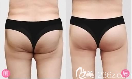 信阳易韩安和吸脂手术前后