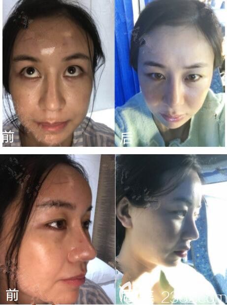韩国ACE整形脂肪填充修复术真人案例 韩国ACE整形脂肪填充修复术真人案例