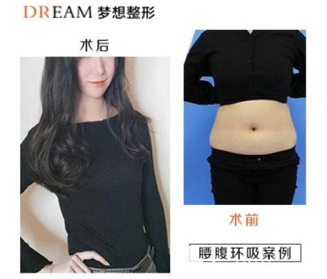 兰州梦想赵梅霞腰腹环吸效果案例 兰州梦想赵梅霞腰腹环吸效果案例