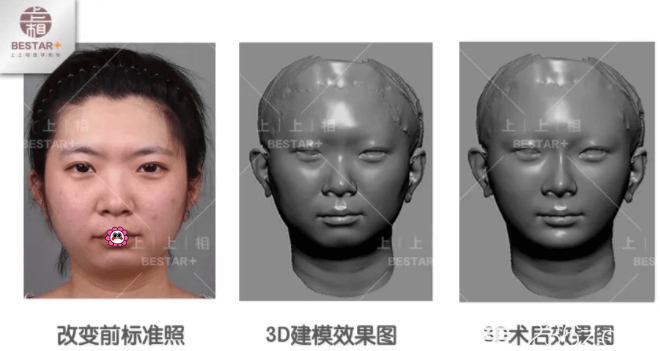 北京上上相医生给我做的自体脂肪填充下巴3D效果模拟图