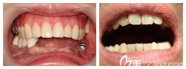 郑州德正口腔种植牙案例