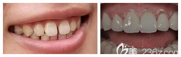 郑州德正口腔牙齿矫正案例