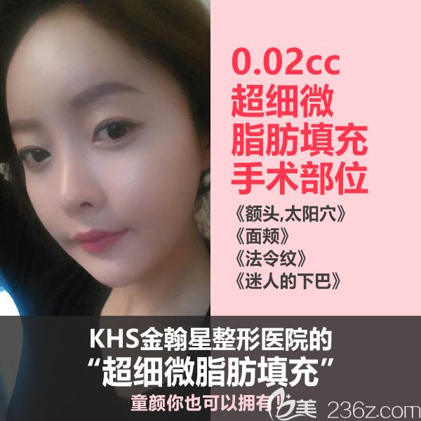 韩国KHS金翰星整形医院超细微脂肪移植 韩国KHS金翰星整形医院超细微脂肪移植
