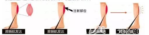 苏州紫馨分享瘦腿原理