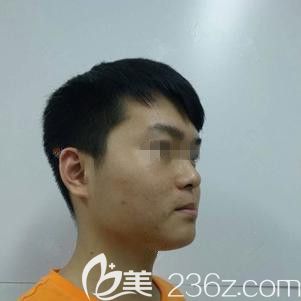 在天伊美整形做光子嫩肤术前皮肤粗糙 在天伊美整形做光子嫩肤术前皮肤粗糙