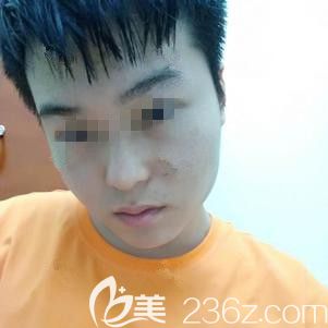 在石家庄天伊美做光子嫩肤术后面部微肿 在石家庄天伊美做光子嫩肤术后面部微肿