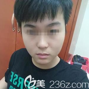 张斌医生为我做光子嫩肤后皮肤透亮紧致 张斌医生为我做光子嫩肤后皮肤透亮紧致