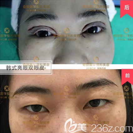 攀枝花奇丽韩式双眼皮术后即刻效果图