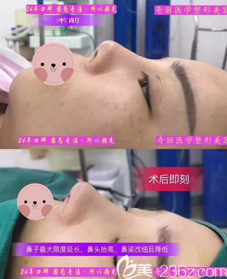 攀枝花奇丽鼻综合术后对比效果图