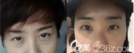 攀枝花奇丽整形美容祛眼袋术前术后对比图