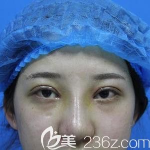 张柏松医生为我刚做完双眼皮手术后有点肿胀