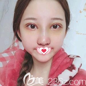 在天伊美整形做切开双眼皮术后7天进行拆线