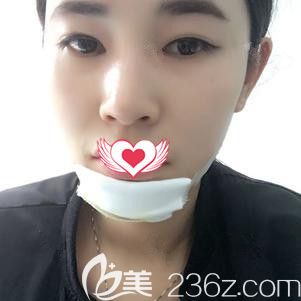 <!--<i data=20240703-sp></i>-->医生为我刚做完硅胶点下术后下巴肿胀