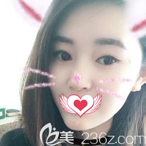 在石家庄天伊美做隆下巴手术10天下巴微肿