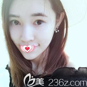 <!--<i data=20240703-sp></i>-->医生为我做硅胶垫下巴术后22天变小V脸