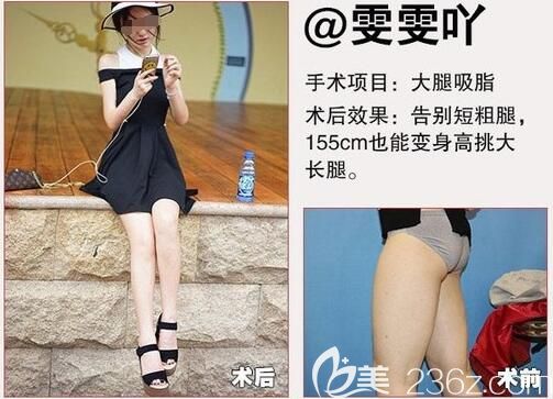 南京速丽分享大腿吸脂案例