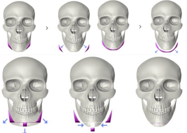 韩国H医院下颌角整形手术方法