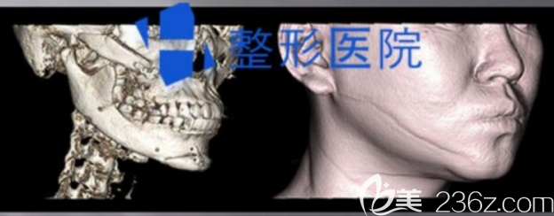 韩国H整形下颌角修复术前CT图片