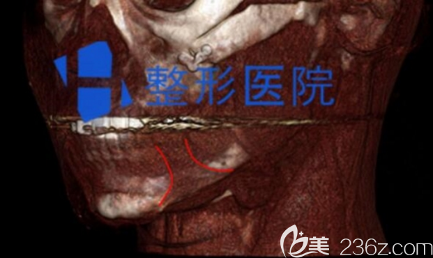 韩国H整形医院下颌角修复术前检查图片