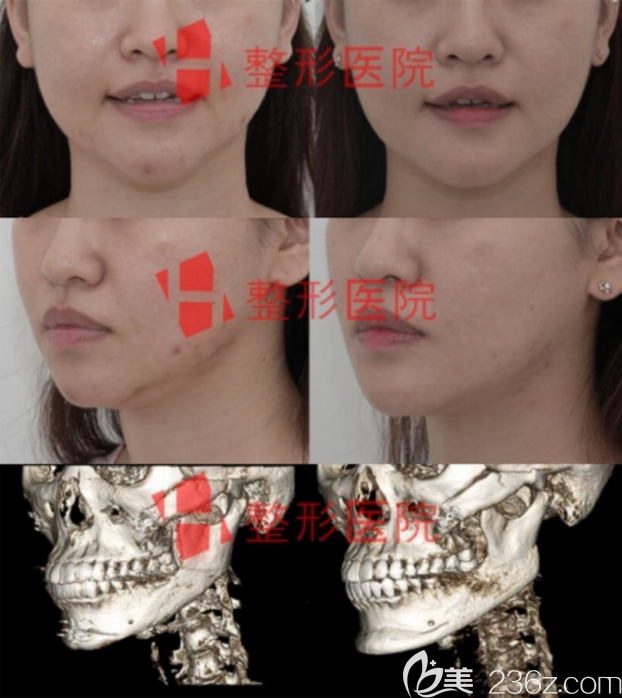 韩国H整形医院白汀桓下颌角修复案例术前术后对比图