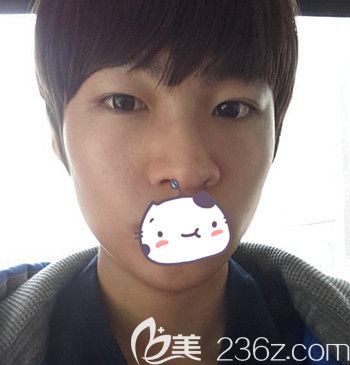 在韩国JJ洪镇柱整形外科做面部轮廓+眼鼻整形手术前 在韩国JJ洪镇柱整形外科做面部轮廓+眼鼻整形手术前