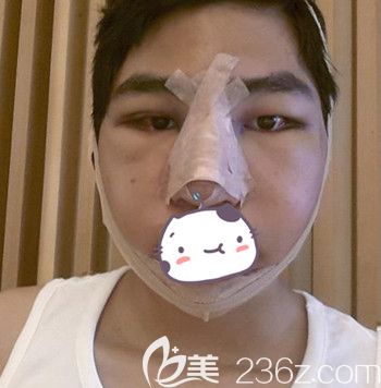 在韩国JJ洪镇柱整形外科做面部轮廓+眼鼻整形手术当天