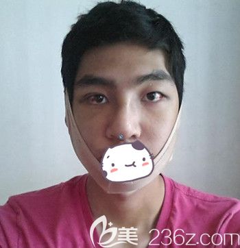 在韩国JJ洪镇柱整形外科做面部轮廓+眼鼻整形手术后1周 在韩国JJ洪镇柱整形外科做面部轮廓+眼鼻整形手术后1周