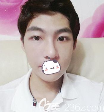 在韩国JJ洪镇柱整形外科做面部轮廓+眼鼻整形手术后1个月 在韩国JJ洪镇柱整形外科做面部轮廓+眼鼻整形手术后1个月